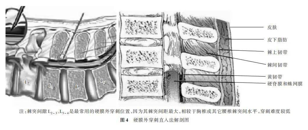 硬膜外阻滞疗法中国专家共识(2020 版)