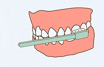 长期菌斑堆积以及牙石形成,会使牙龈红肿,出血,萎缩,牙齿松动甚至脱落