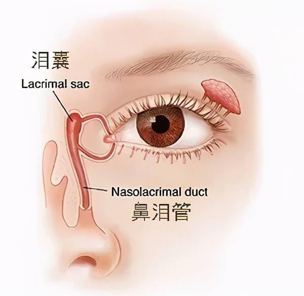 鼻泪管在鼻腔的下端出口,被一层薄膜封闭或因上皮细胞残渣堵塞