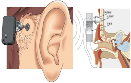 【辅具资讯】人工听觉技术(上)_助听器