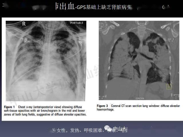 肺出血的影像学特征