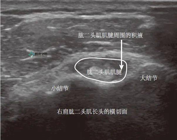 疼痛解剖学肱二头肌肌腱炎