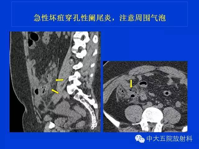 全面讲解正常阑尾和阑尾炎的ct表现