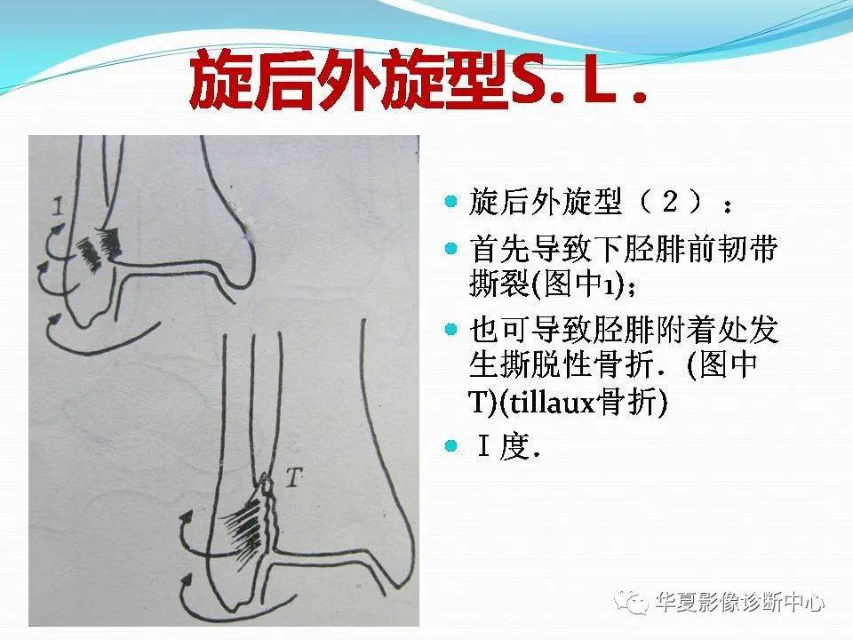 踝关节骨折的分型