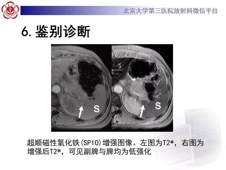 副脾蒂扭转少见部位副脾影像表现