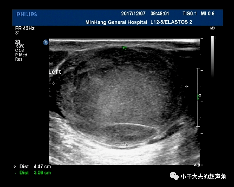 超声随响〗第60期 睾丸精原细胞瘤 最常见,同时迷惑