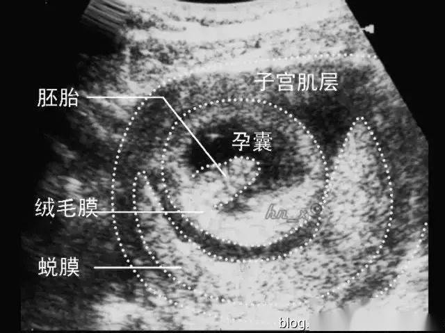 妇产科超声:胚胎着床位置及妊娠囊的超声表现,如何解读?