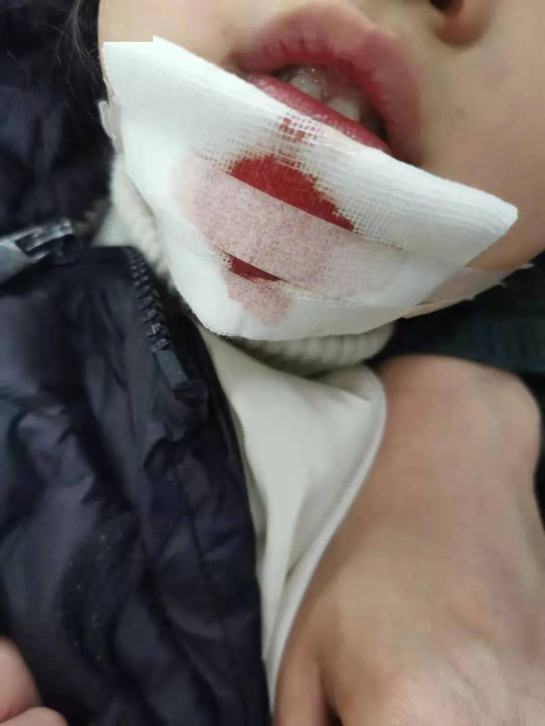 网友爆料:孩子在如皋安定幼儿园摔伤破相缝合13针,园方律师告知家长
