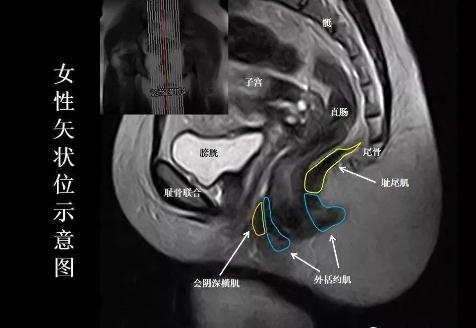 8张图带你熟悉盆底mri解剖