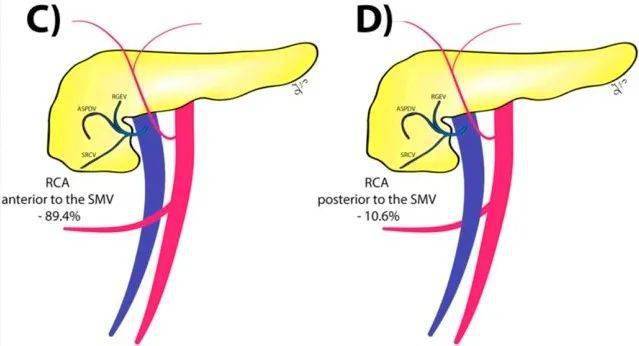 图(2):rca与肠系膜上静脉的关系