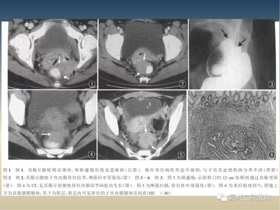 子宫内膜异位症影像诊断
