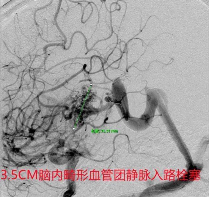 众所周知,脑内深部巨大脑血管畸形的治疗一直是神经外科学的难点.