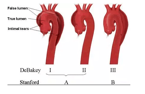 胸部突然剧痛!血管外科专家:高血压引发主动脉夹层