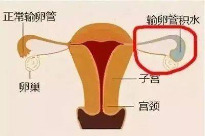 如何让薄子宫内膜变"沃土",更利于怀孕?