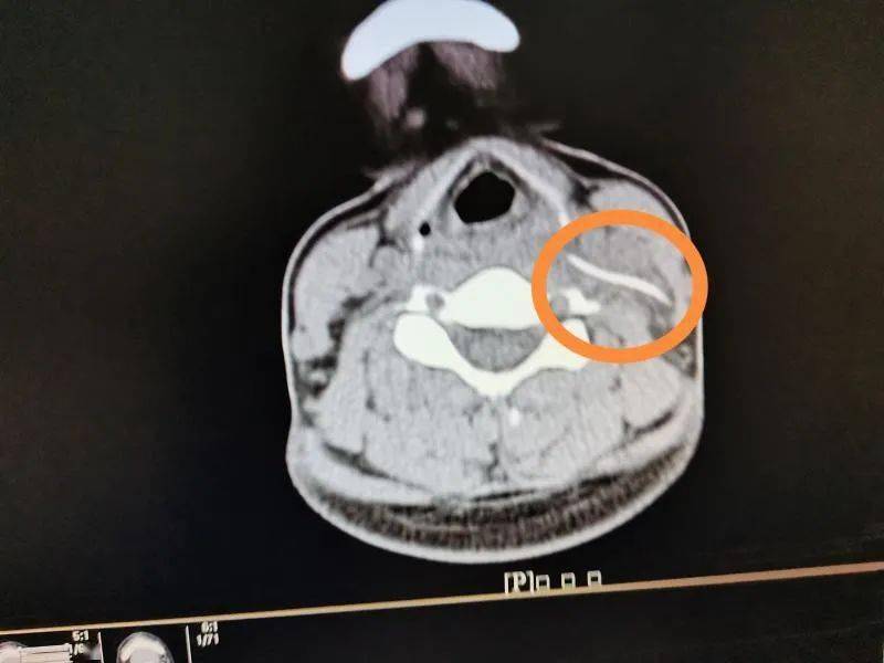 术中见一鱼刺横行于甲状软骨平面的咽旁间隙内,紧贴颈内静脉,颈总动脉