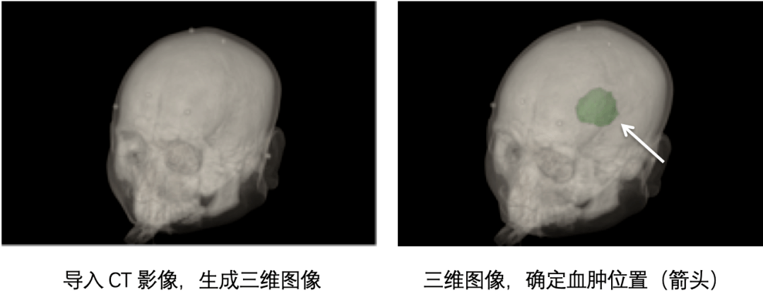 术前准备阶段,根据患者头颅ct检查,进行了三维重建,精准确定血肿位置