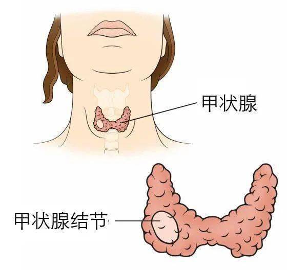 巨大甲状腺肿