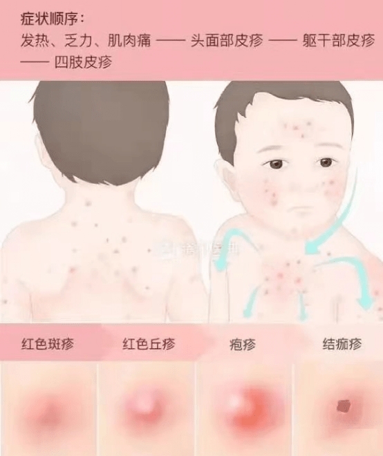 平罗县疾控:最有效的预防措施是接种水痘疫苗