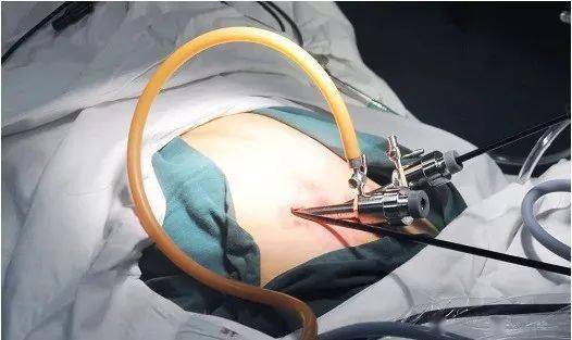 【医疗技术】患者求美来院切除胆囊,我院单孔腹腔镜:安排