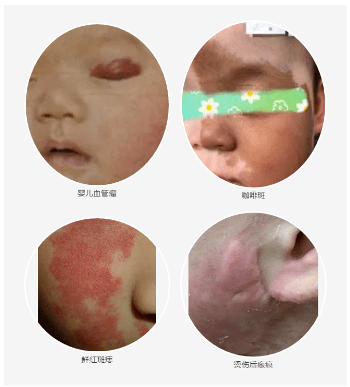 浙大儿院成立儿童皮肤美容激光中心 咖啡斑,太田痣,血管瘤,瘢痕等儿童