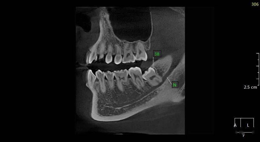 孙xx 20210424 智齿cbct 158xxxx2993