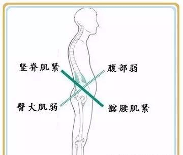 骨盆前倾毁了多少健身女孩