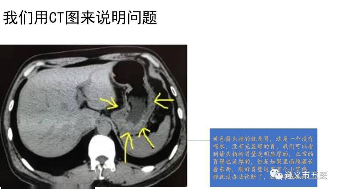 科普||腹部ct检查为什么要多喝水?