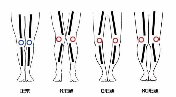 x型腿是多是膝盖内翻,造成原因无外乎股骨内收,内旋和胫骨骨外展,外旋