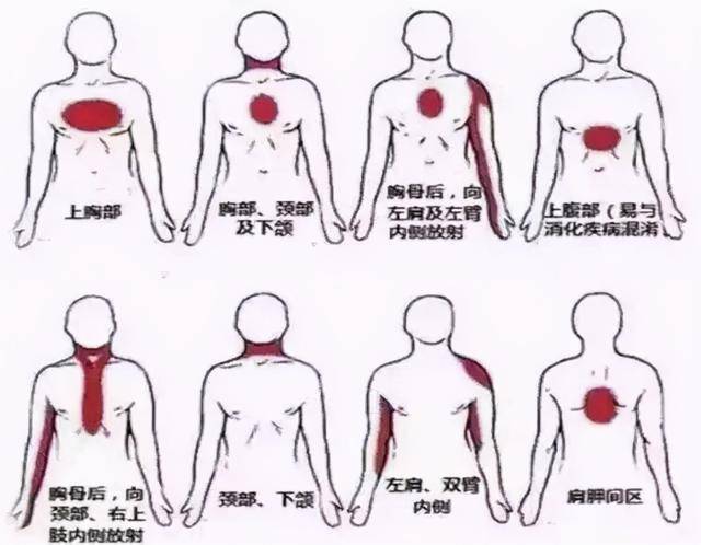 后背疼痛怎么会是心肌梗死?