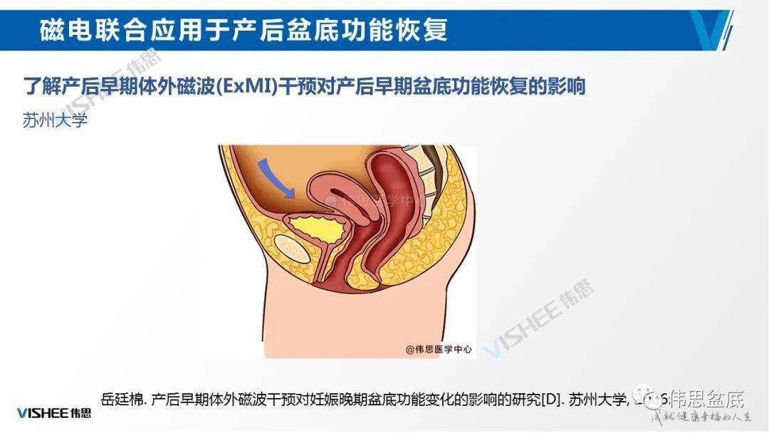 阴道突出肿物?别担心,磁刺激疗法来了