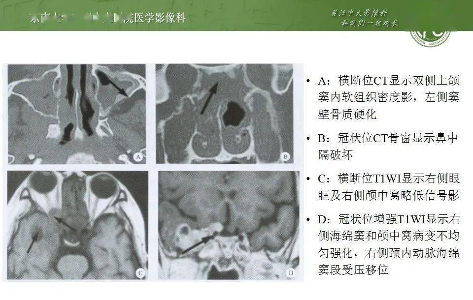 鼻窦解剖及真菌性鼻窦炎影像诊断与鉴别