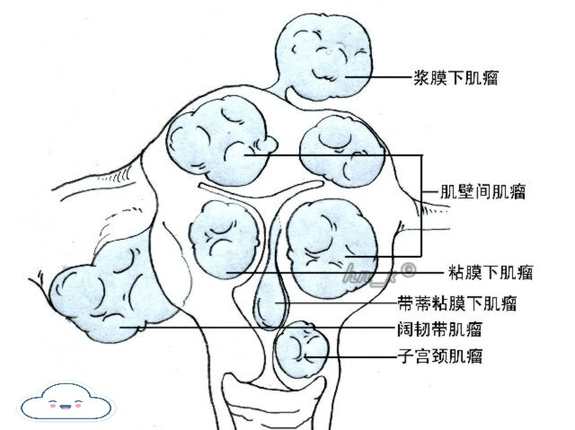 肌壁间肌瘤,浆膜下肌瘤,其他特殊类型或部位的肌瘤(子宫颈,宫角,阔