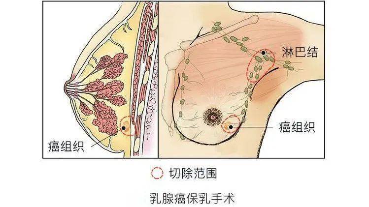 得了乳腺癌只能一切了之?不不不,保乳手术了解一下