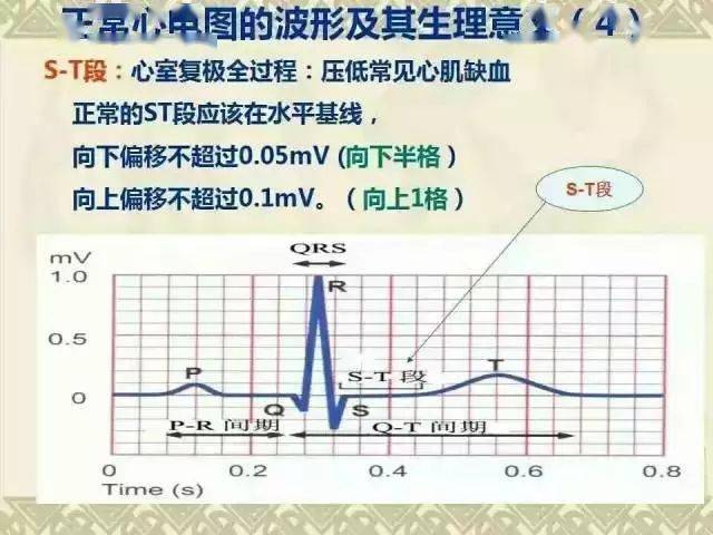 心电图经典图谱