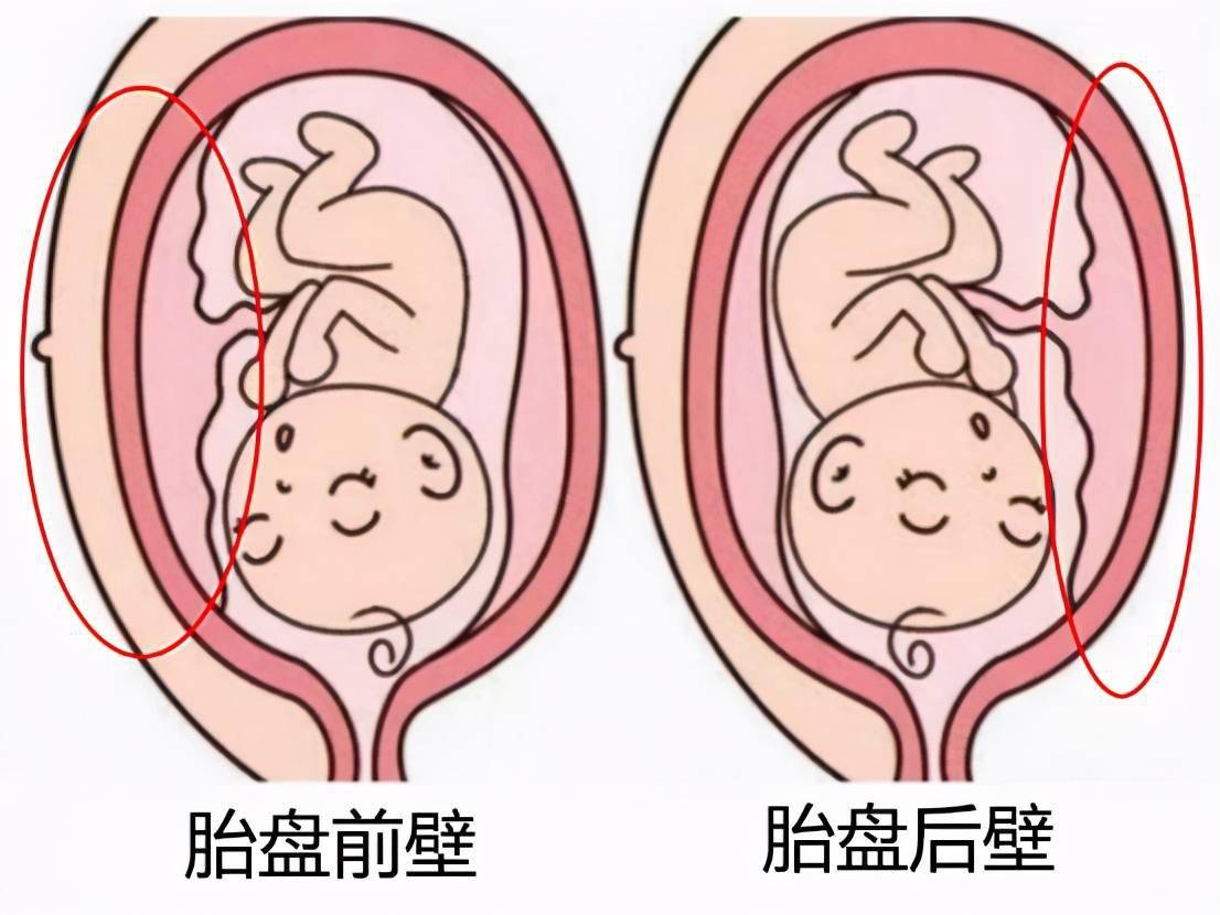 怀孕后是胎盘前壁好还是后壁好,你怎么看?_位置