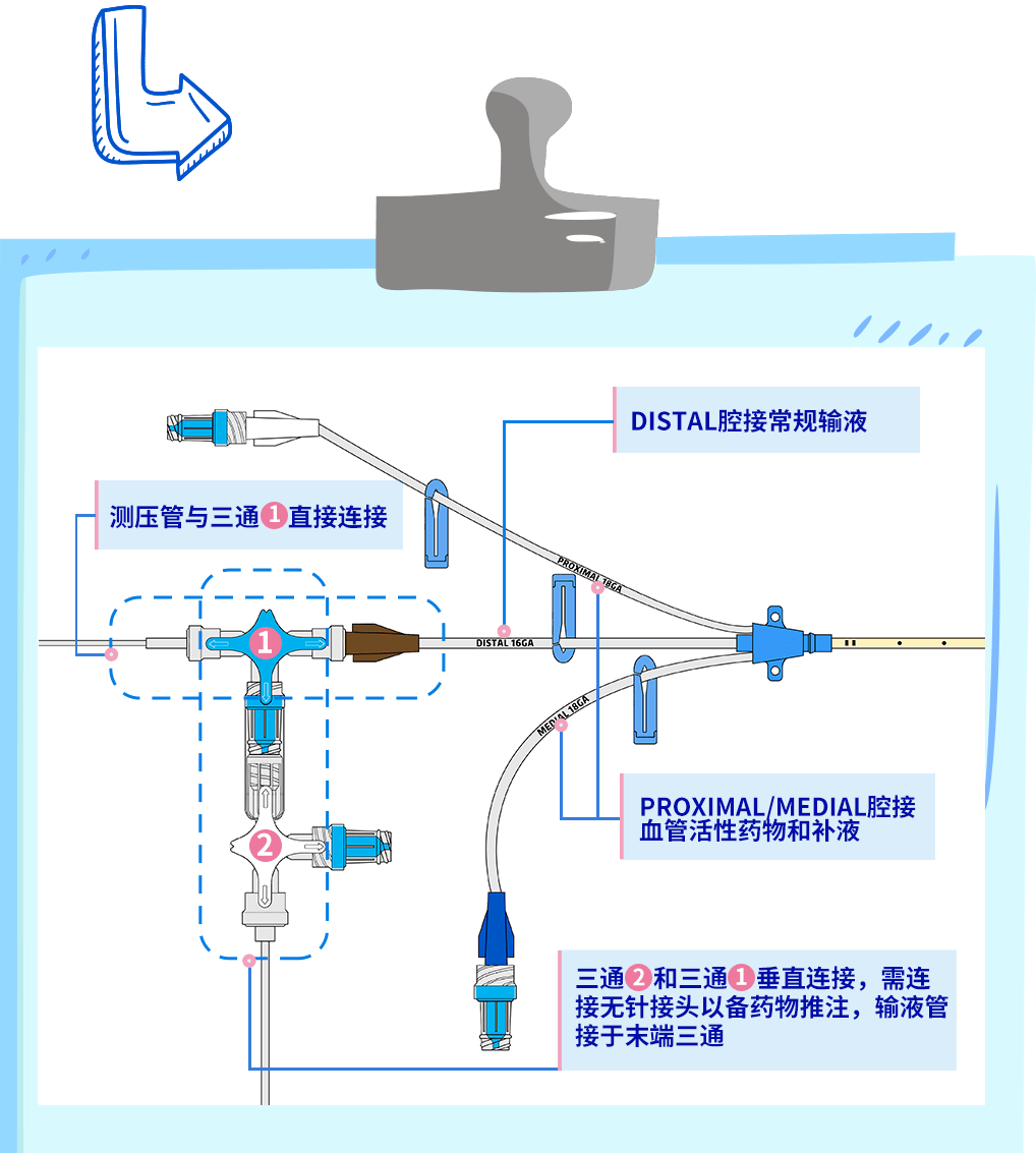 使用三通测量cvp,你的连接方式对嘛?_导管