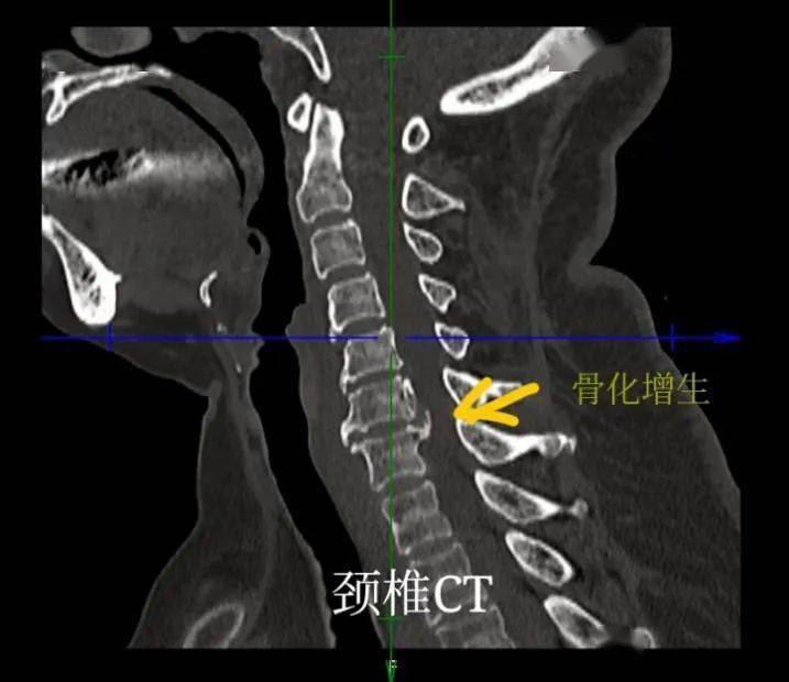 颈椎后纵韧带骨化是颈椎手术的难点,要彻底的切除骨化物而且避免损伤