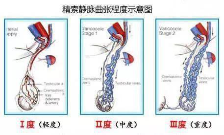 这几种男性危机可能需要借助辅助生殖技术生孩子