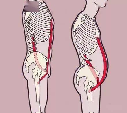 如何判断自己是否骨盆前倾