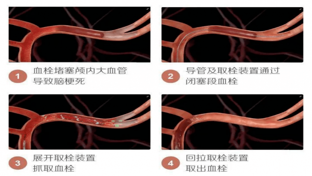 简单来说,脑动脉取栓就是采用导管技术,将取栓装置从患者的股动脉送