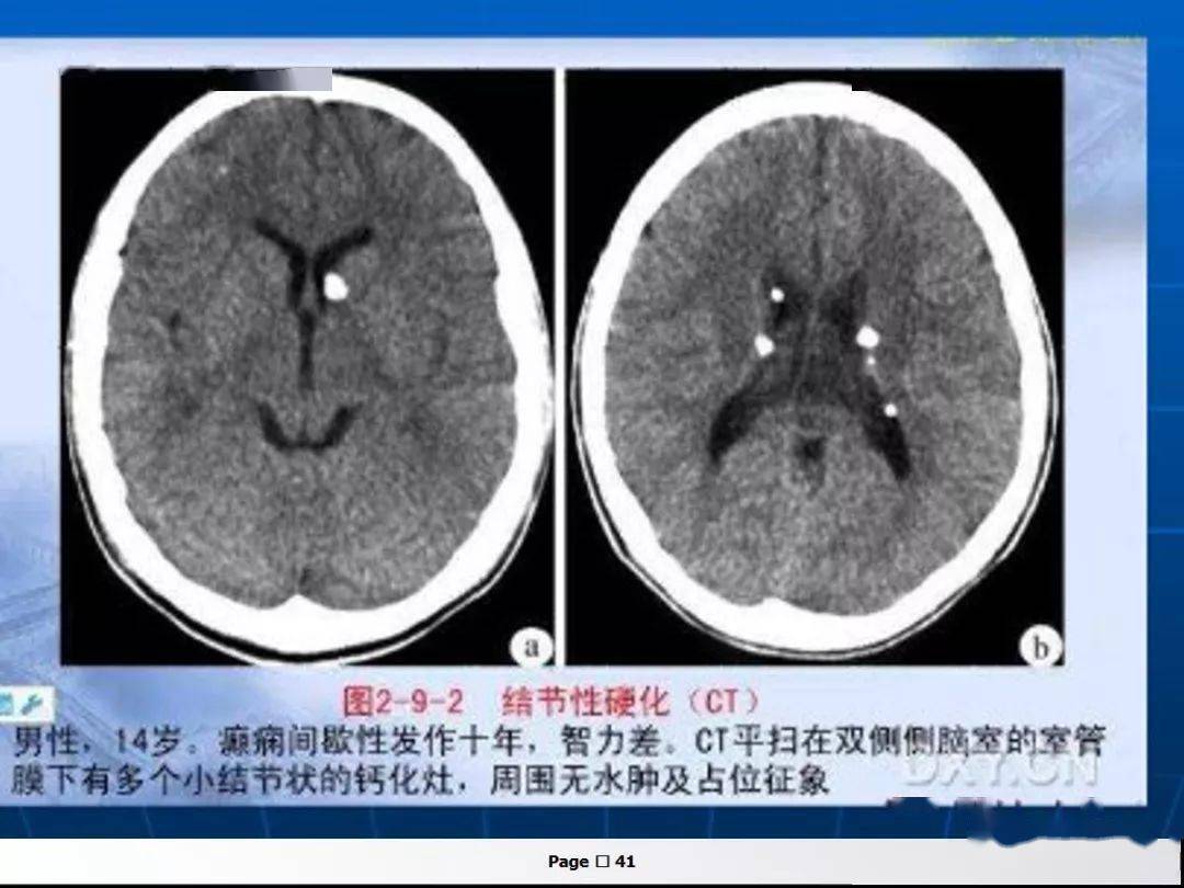 详情查看链接:《 无需坐3)条样,脑回样,铁轨样,圆点状钙化是血管