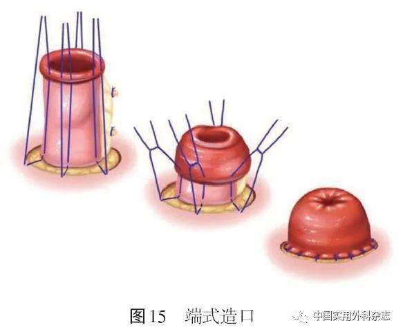 2 回肠袢式造口(图16) (1)选取合适造口位置和大小,切开皮肤,皮下组织