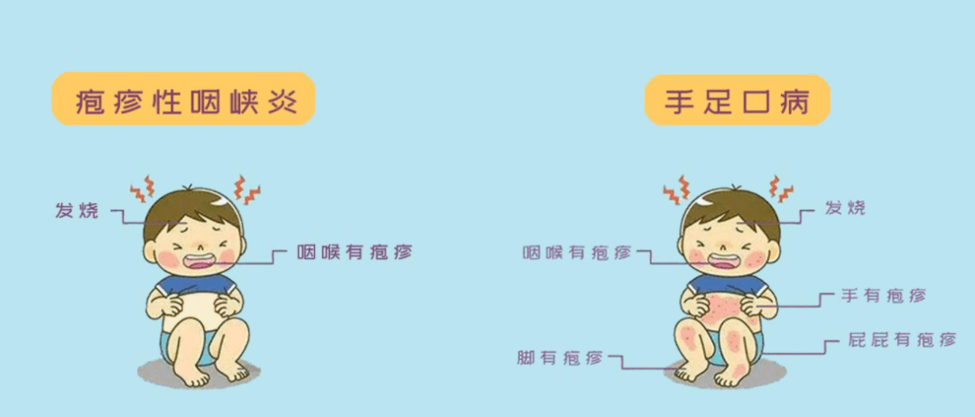 【卫生保健】疱疹性咽峡炎小知识