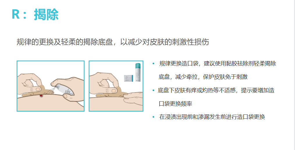 8, 更换完造口袋后,用手轻轻放于造口底盘上月5~10 分钟,用双手的温