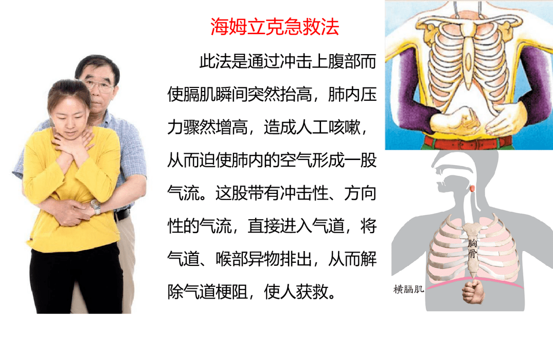 海姆立克急救法又救人一命!赶紧学起来!