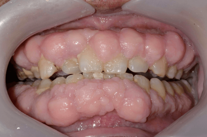该患者是硝苯地平引起的药物性牙龈肥大,必须和心内科医师协同