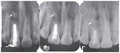 【病例分享】外伤牙根尖诱导成形术后形成异位牙根一例