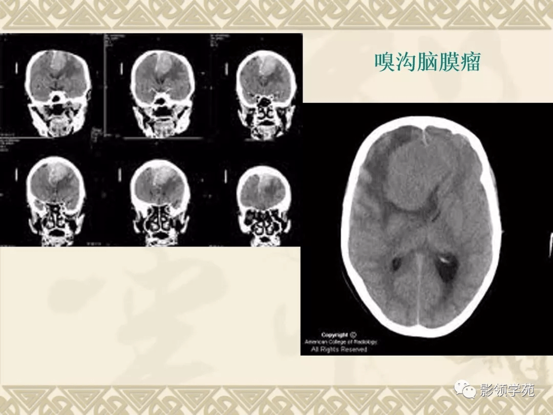 常见脑肿瘤的影像诊断