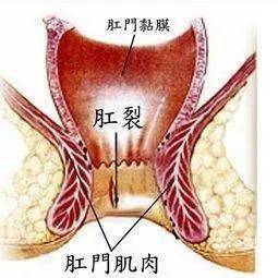 肛裂——痛苦的难言之隐