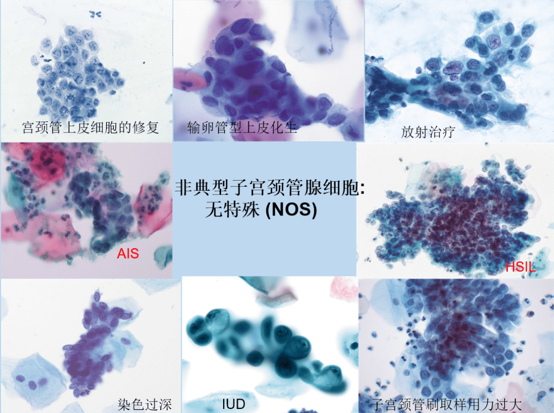 用ai进行大规模宫颈癌筛查巧思真的做到了